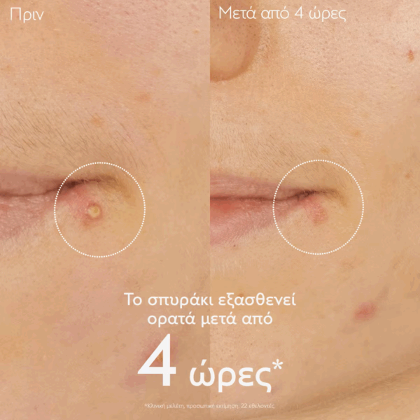 Caudalie Vinopure Stop Boutons Ενυδατική Κρέμα Προσώπου Ημέρας 15ml - Image 3